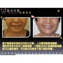 Cosmetic Dental Implants - Dental Implants-7